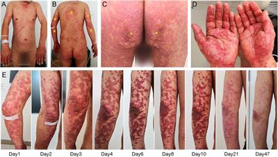 Toxic Epidermal Necrolysis-Like Reaction Following Combination Therapy With Camrelizumab and Apatinib for Advanced Gallbladder Carcinoma